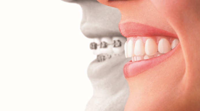 マウスピース型矯正装置の特徴