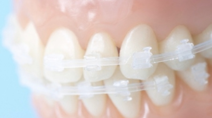 部分矯正の特徴